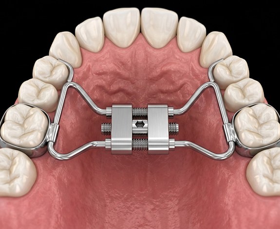 Digital image of palatal expander attached to teeth
