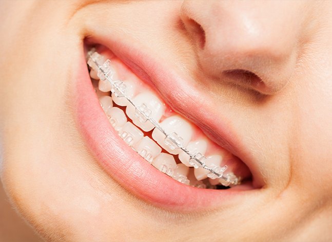 Close up of smile with clear ceramic braces