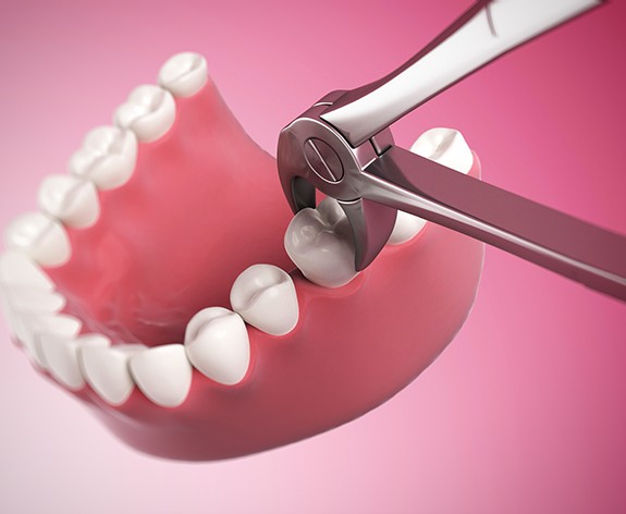 a 3D illustration of an orthodontic tooth extraction