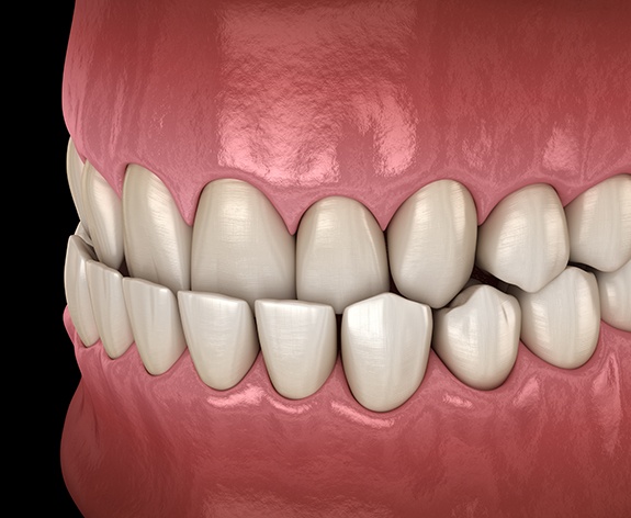 a 3D illustration of an underbite