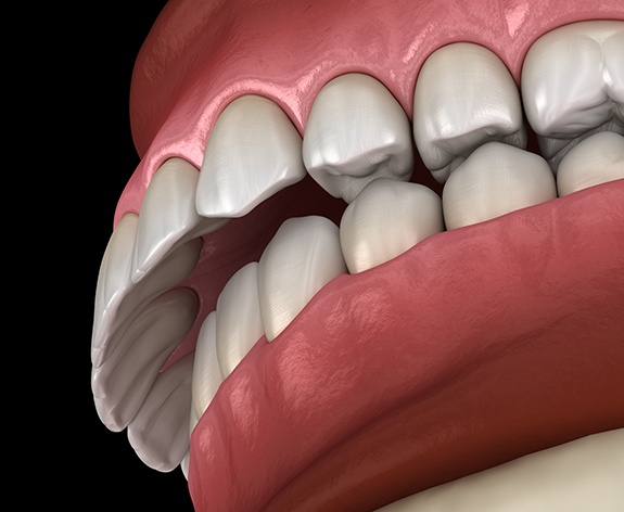 a 3D illustration of an overbite