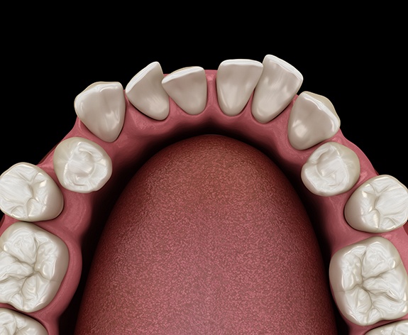 a 3D illustration of crooked teeth