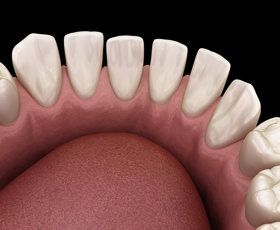 a 3D illustration of gaps between teeth