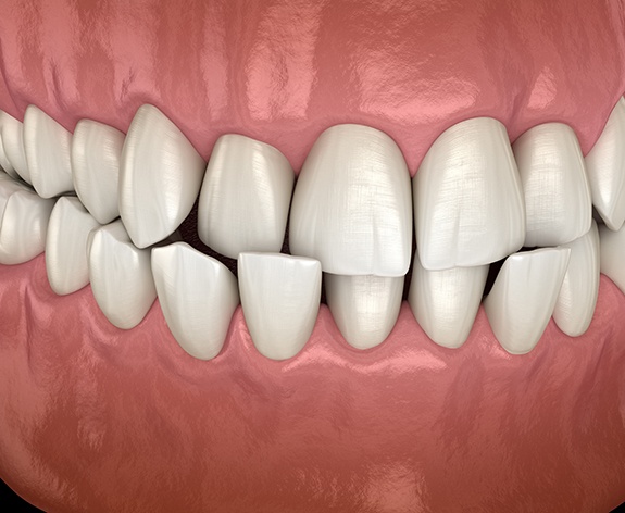 a 3D illustration of a crossbite