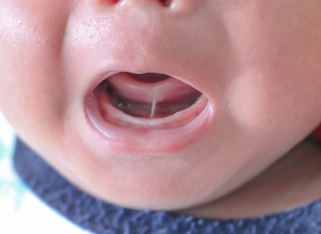 a baby with a tongue tie