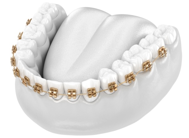 Animated arch of teeth with gold braces