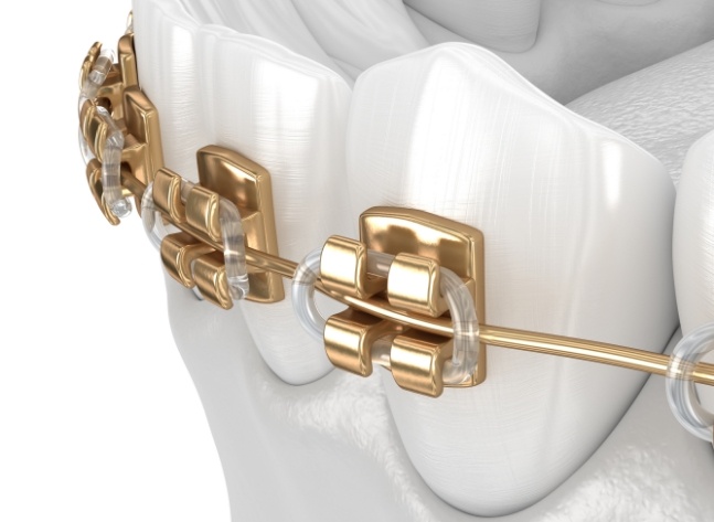 Close up of a few animated teeth with gold braces