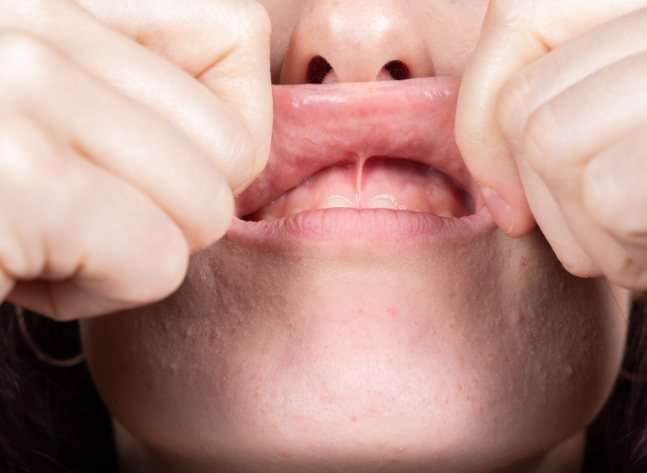 Close up of person lifting and stretching out their upper lip