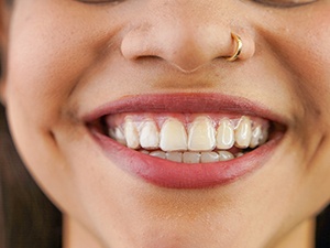 Closeup of woman smiling while wearing Invisalign aligners