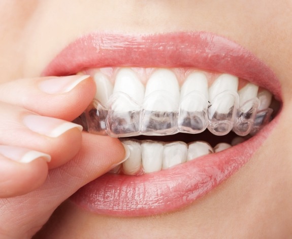 Close up of person placing Invisalign tray over their teeth