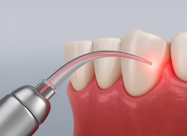 Illustration of soft tissue laser being used on gums