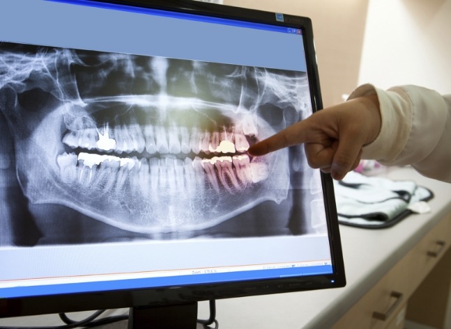 Dentist pointing to digital x rays of teeth on computer screen