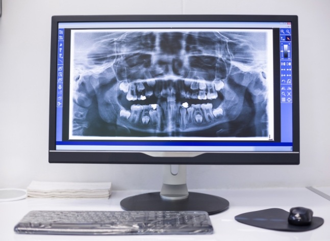 Computer screen showing digital dental x rays