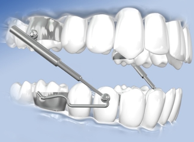 Animated Herbst oral appliance being worn over the teeth