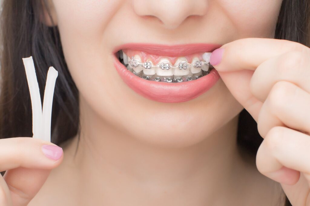 Nose-to-neck closeup of woman placing orthodontic wax on braces