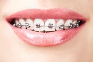Close-up of braces on teeth.