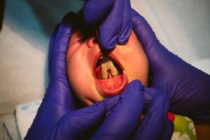 Baby undergoing frenectomy treatment.